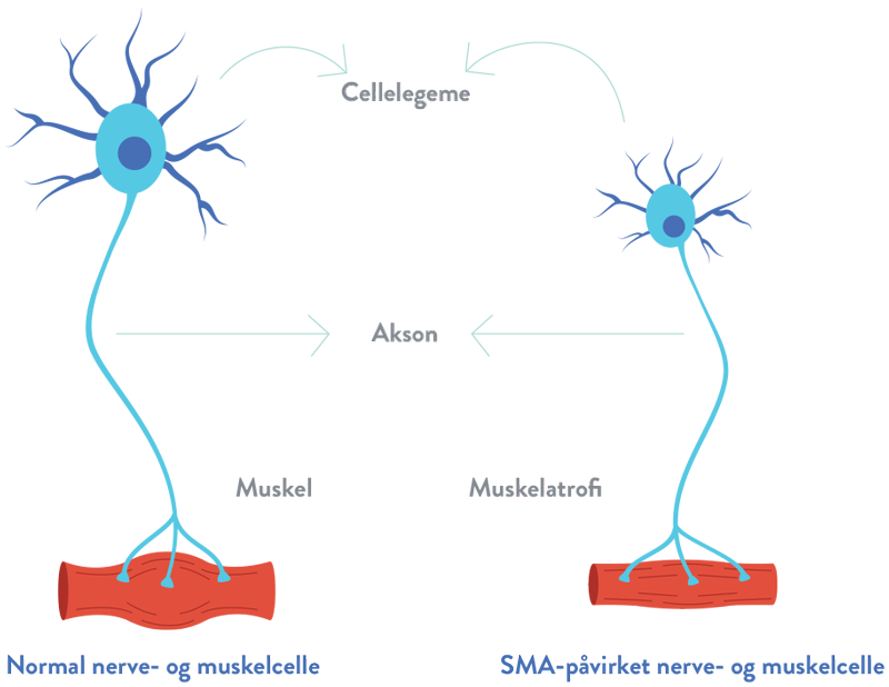 Spinal Muskelatrofi SMN  protein