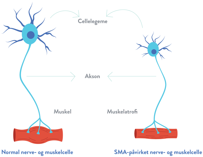 Spinal Muskelatrofi SMN  protein